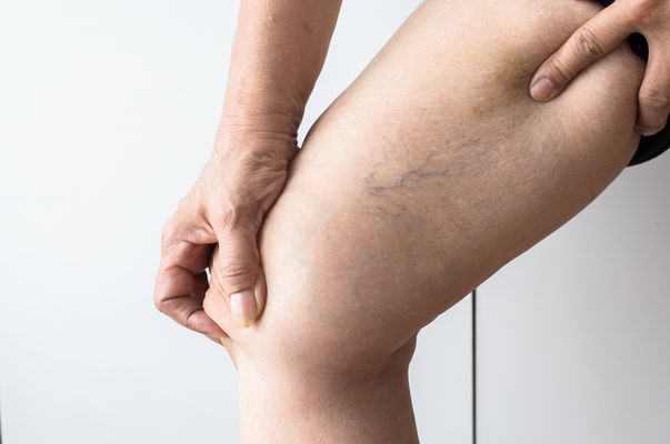 krampfadern und wadenkrämpfe Wadenkrämpfe Krampfadern Hämorrhoiden Entsäuerung Natron Natronkur Weinstein Weinsteinkur Atmung Atemübungen Drüsenübungen Ernährung vegetarisch Petrolatum Mentholcreme Klopfmassage