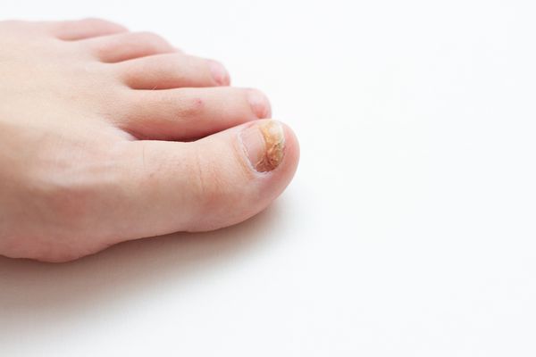 nagelpilz und verkrüppelte zehennägel Nägel Nagelpilz Mohn-Zimt-Öl