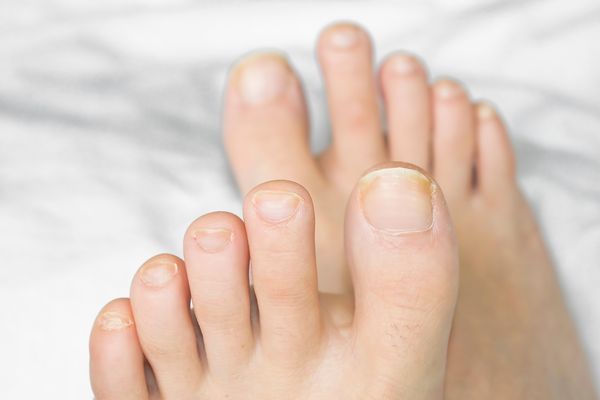 mohn-zimt-öl gegen nagelpilz Nägel Nagelpilz Mohn-Zimt-Öl