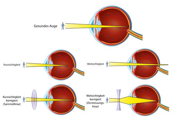 sehschärfe verbessert nach augenbädern Augen Augenbäder Sehschärfe
